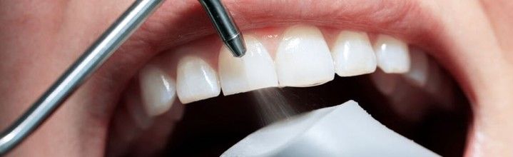 Как часто можно делать профессиональную чистку зубов